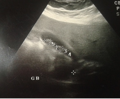 Safrakesesi ultrason görüntüsü